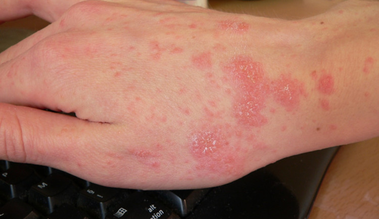 Svrab se Prahou šíří rychleji, než v minulých letech. Případů už je 300