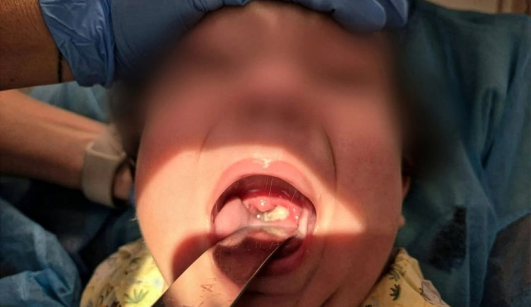 Ostravští lékaři úspěšně vyléčili tři případy vzácného záškrtu